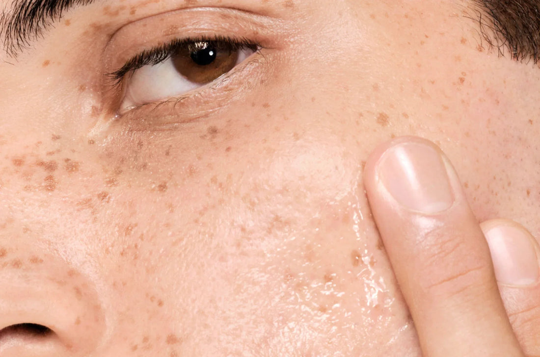 Comment nettoyer et prendre soin de sa peau grasse à tendance acnéique