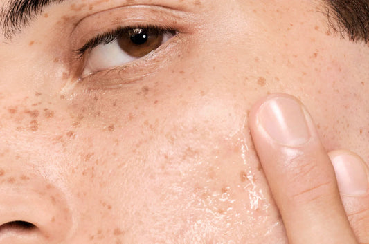 Comment nettoyer et prendre soin de sa peau grasse à tendance acnéique
