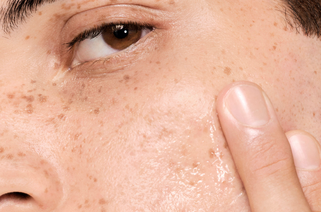 Comment nettoyer et prendre soin de sa peau grasse à tendance acnéique