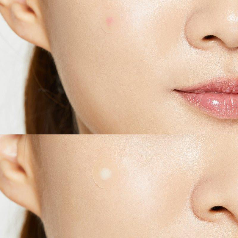 COSRX Acne Pimple Master Patch 24patches - Coree Beauty