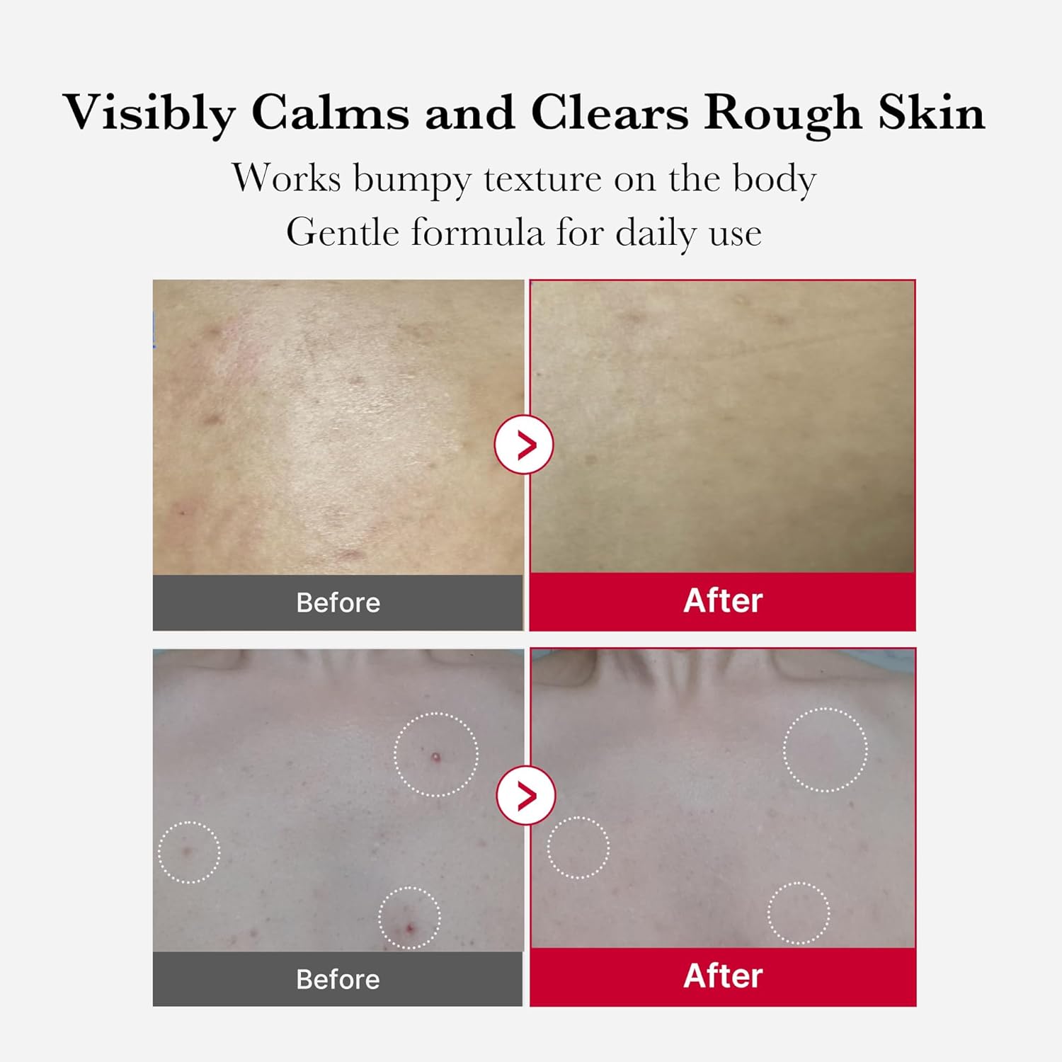 medicube Red Acne Body Peeling Shot