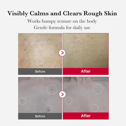 medicube Red Acne Body Peeling Shot